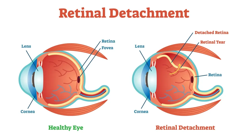 retinal detachment
