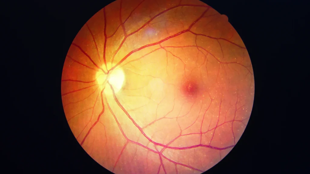 macular hole