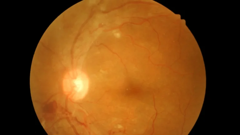 retinal vein occlusion