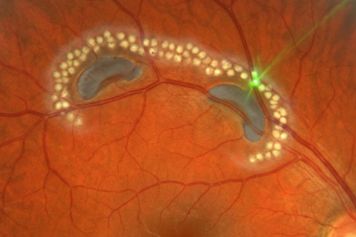 Laser Treatment