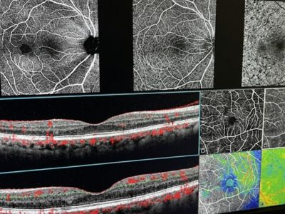 OCTA (OCT Angiography)