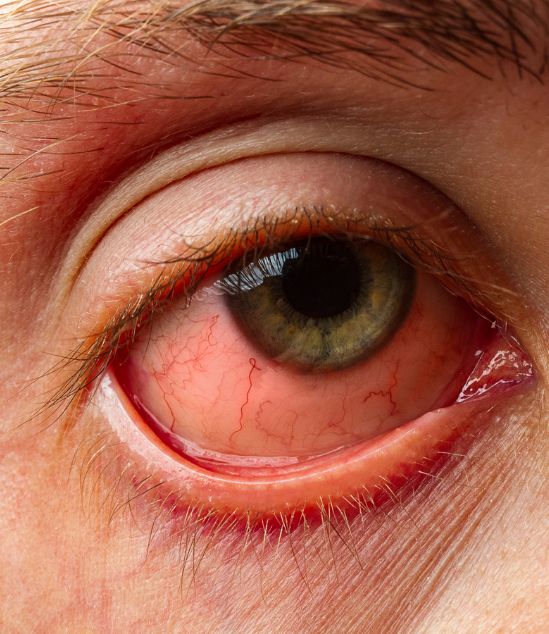Uveitis
