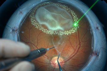 Vitreoretinal Surgery