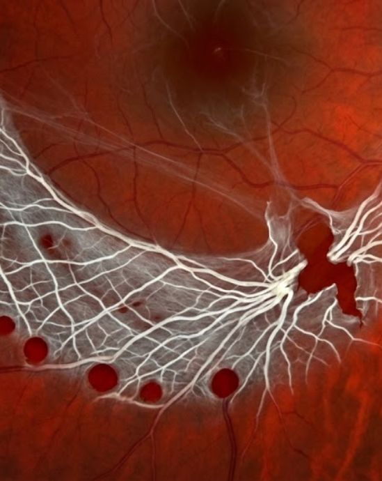 What is Lattice Degeneration