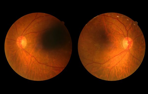 What to Do After a Diabetic Retinopathy Diagnosis