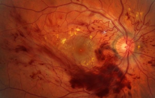 Causes Bleeding in the Eye