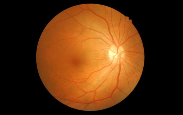 Retinal Vein Occlusion