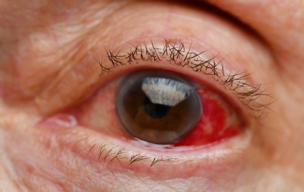Intravitreal Injection