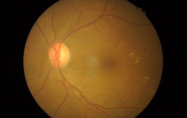 Retinal Detachment Symptoms